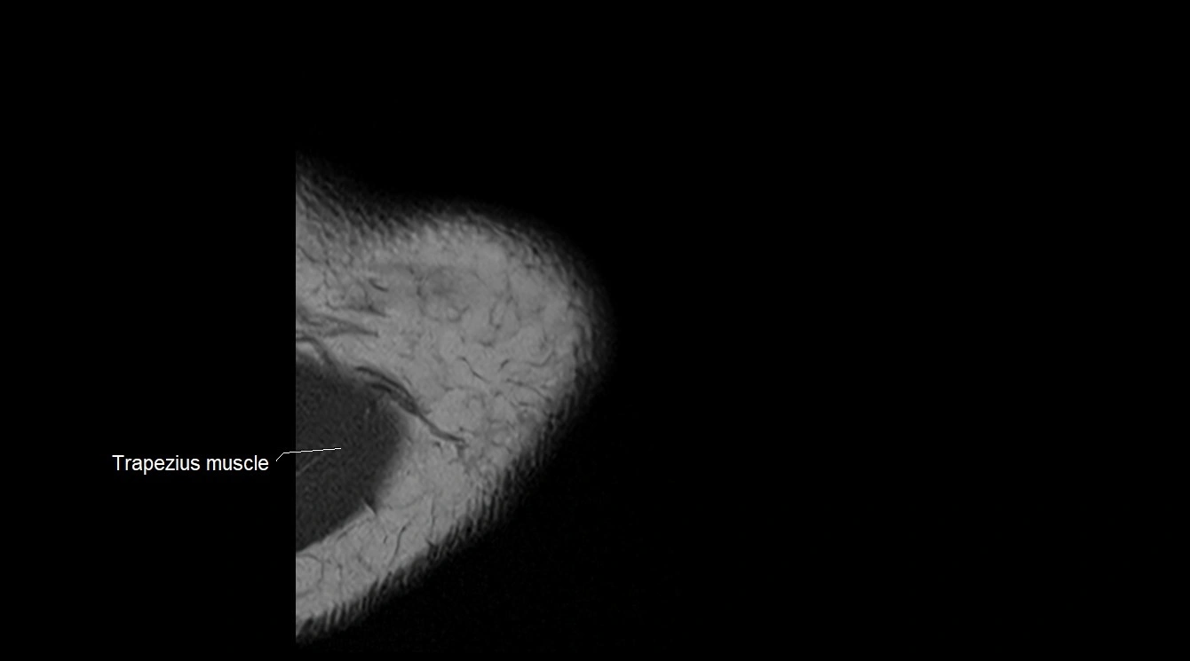 Upper arm( humerus) cross section anatomy MRI 3T axial image 2.webp